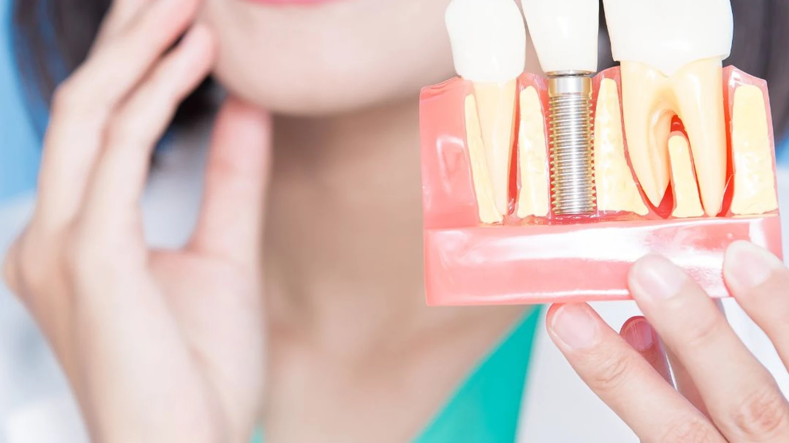 Implantes dentales en Providencia en Dental Providencia