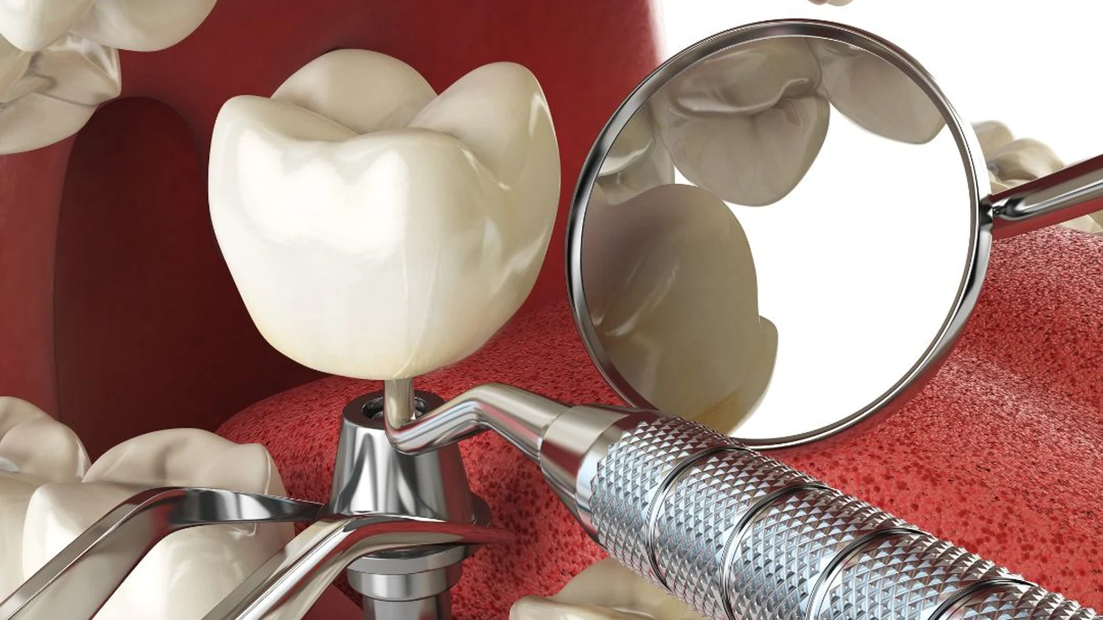 Implante dental unitario para reemplazar una pieza perdida