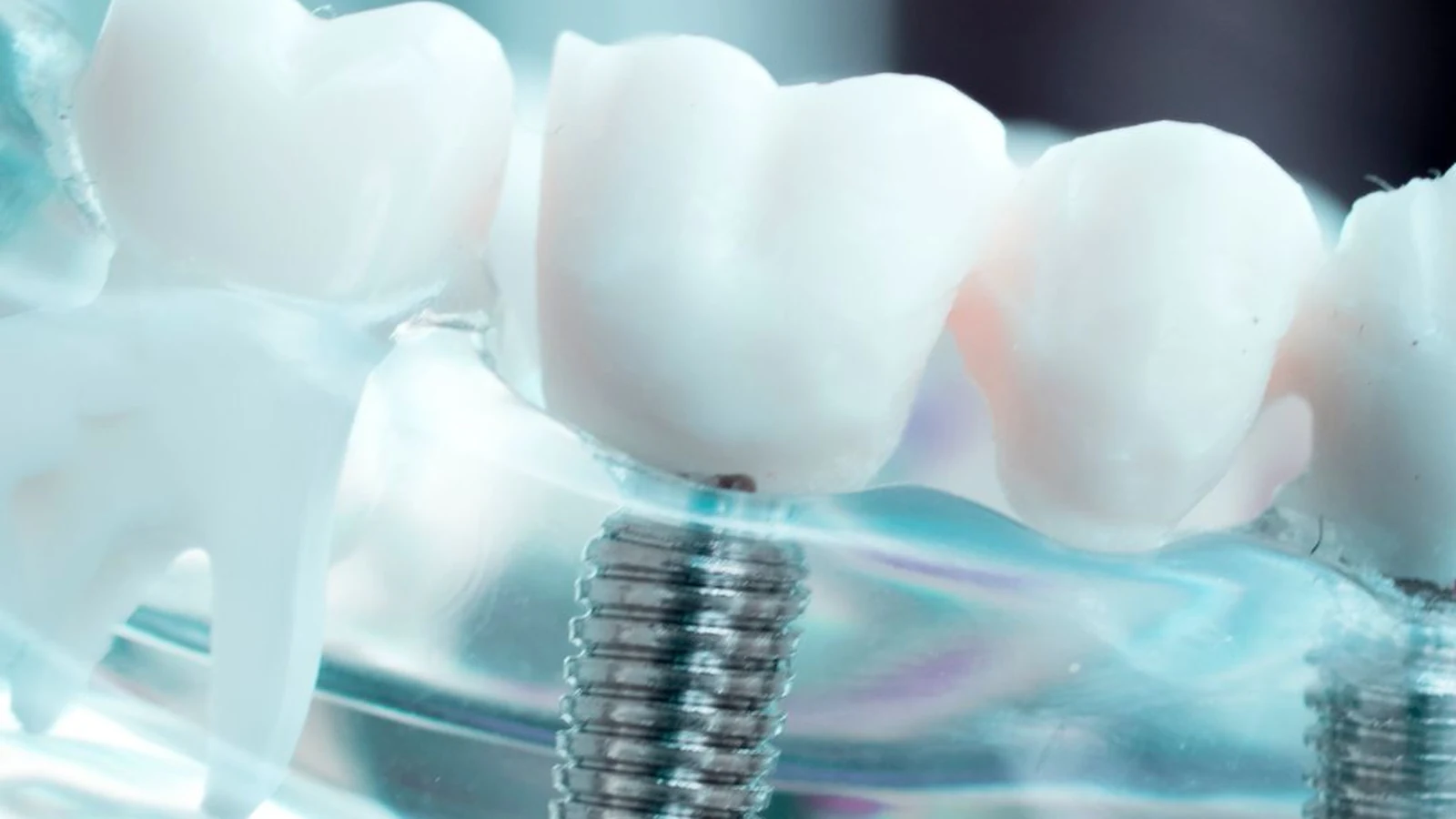 Implantes dentales en Providencia en Dental Providencia