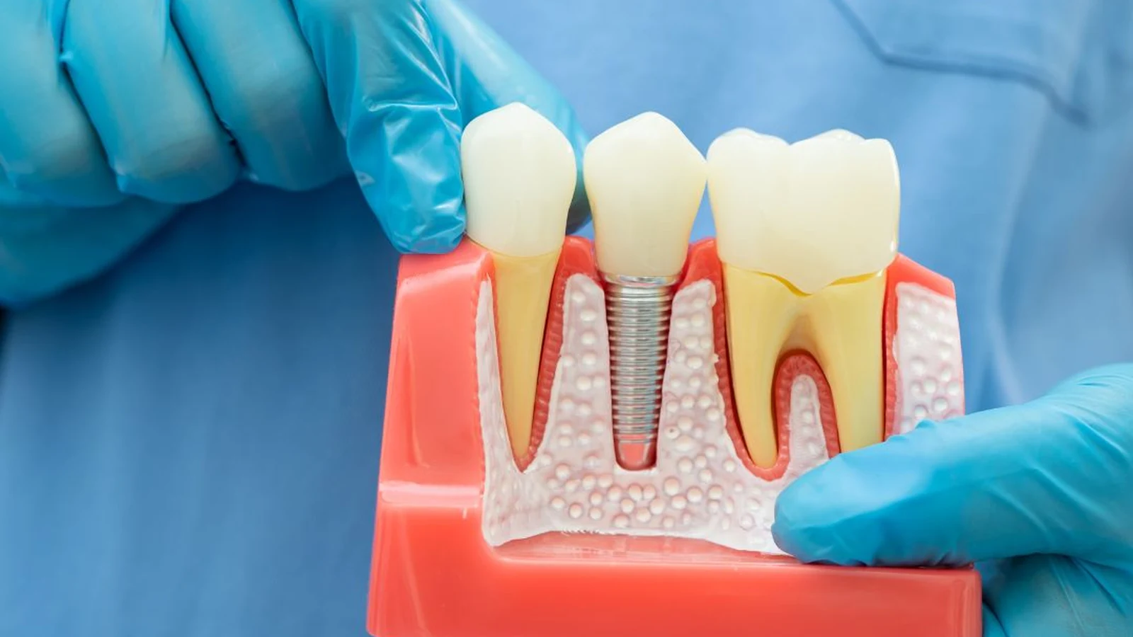 Evaluación odontológica para conocer el precio de implantes dentales
